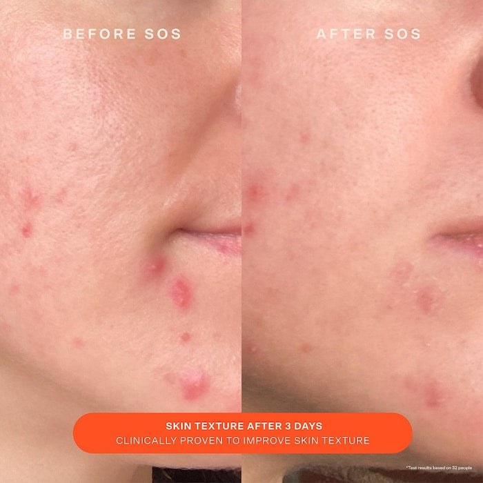 SOS Daily Skin Barrier Redness Recovery Moisturizer - Tower 28